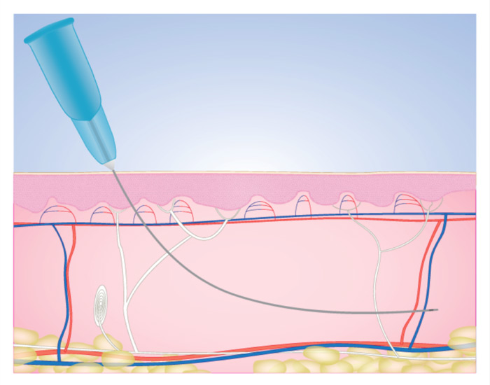  cannula NEEDLE